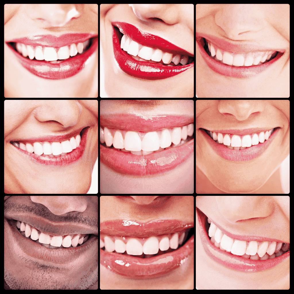 Teeth Whitening 2