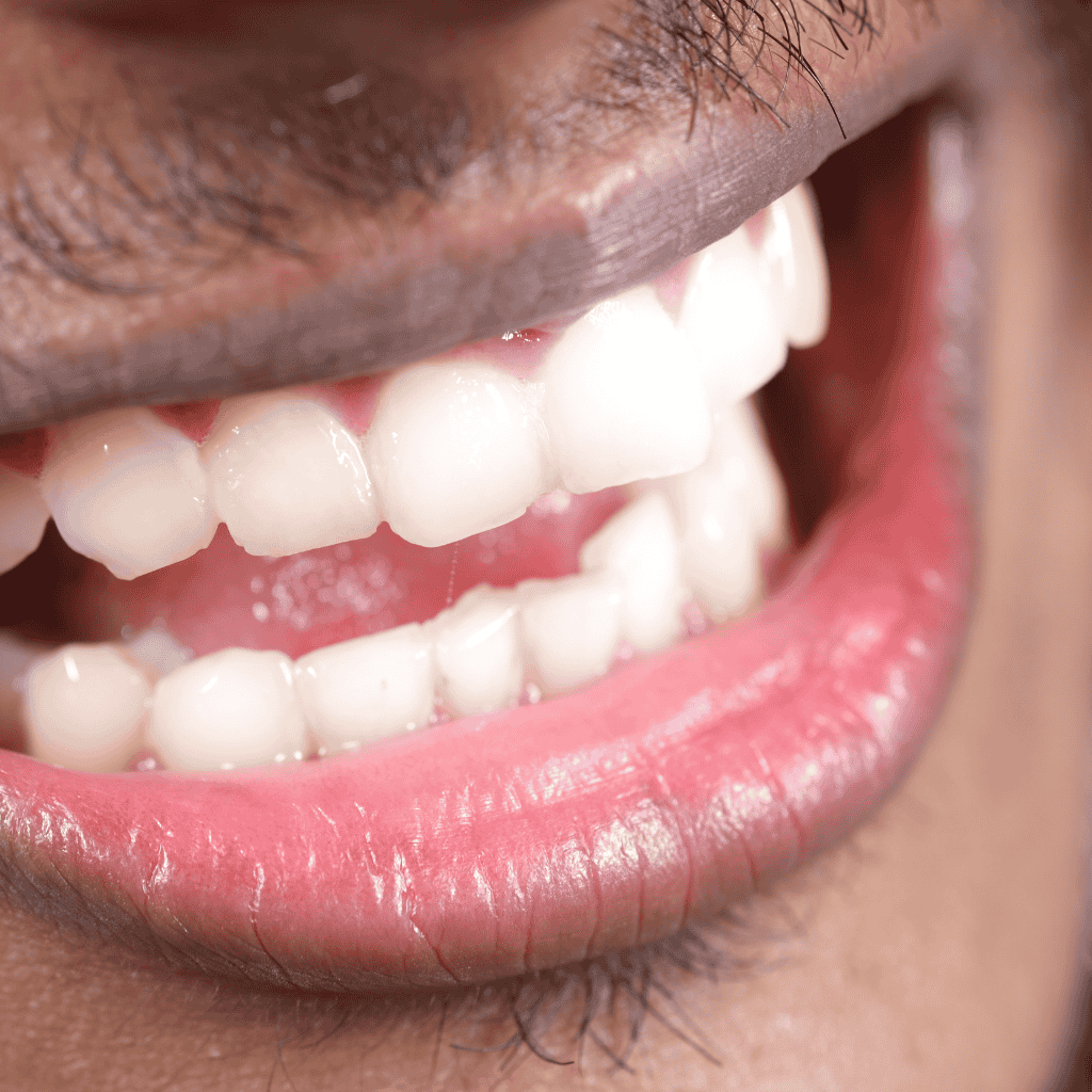 Teeth Whitening 3